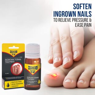 URIEL UPGRADED Ingrown Toenail Treatment向内生长脚趾甲去除