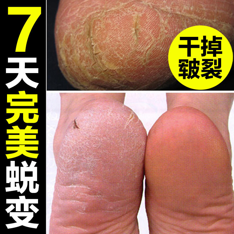 治疗脚干裂脱皮手上起皮干燥马油护手霜手足修护霜手粗糙手裂纹