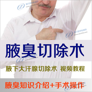 腋臭切除术狐臭臭汗症腋下大汗腺翻转剪除切除术抽吸刮除