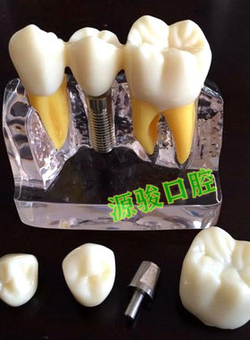 牙科 4倍种植解模型 可拆卸 连桥牙冠 种植钉 演示种植修复牙模