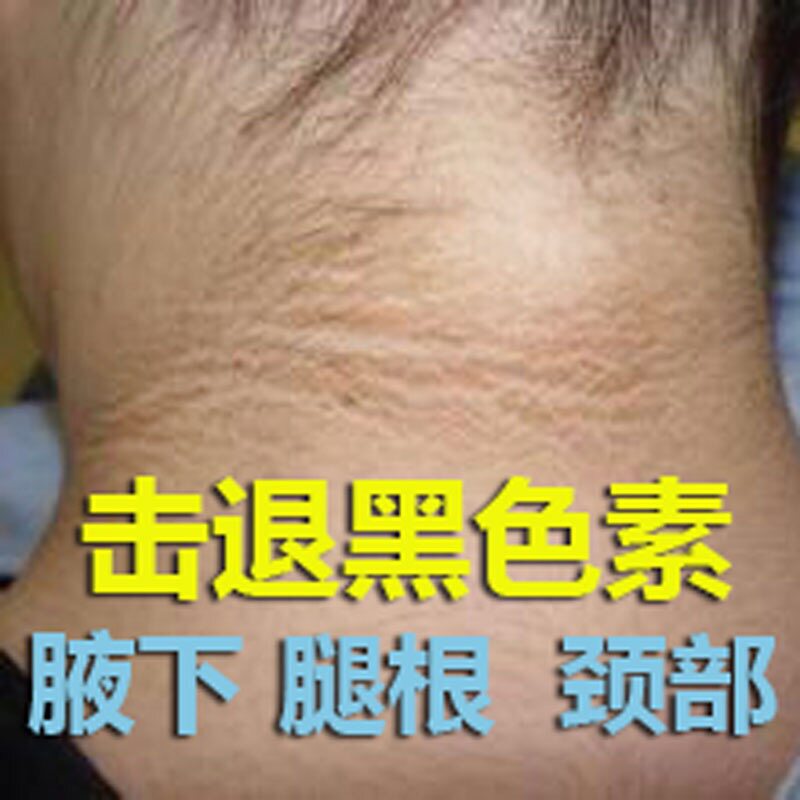 黑脖子洗不干净腋窝手臂大腿内侧棘皮美白去黑色素沉淀