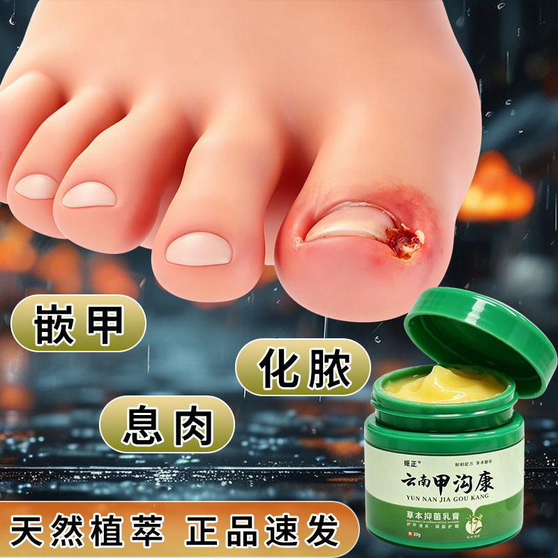 云南甲沟康修复趾指甲去息肉嵌甲甲板增厚指甲发黄空甲萎缩