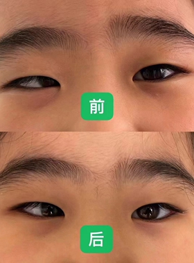 草本斜视修复 改善斗鸡眼内斜外斜视眼睛不聚焦重影眼红眼疲劳