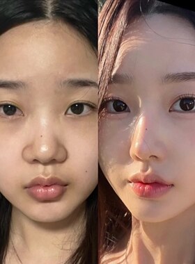 草本鼻尖肥大圆钝修复的精华  缩鼻美鼻立体鼻部精油