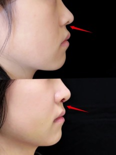 草本瘦鼻小柱硬骨软骨精华  提拉紧致缩小改善肥大天然加强版