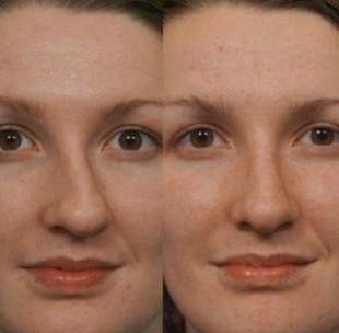 草本鼻中隔偏曲修复精华  改善歪鼻偏移不规则立体美鼻精油加强版