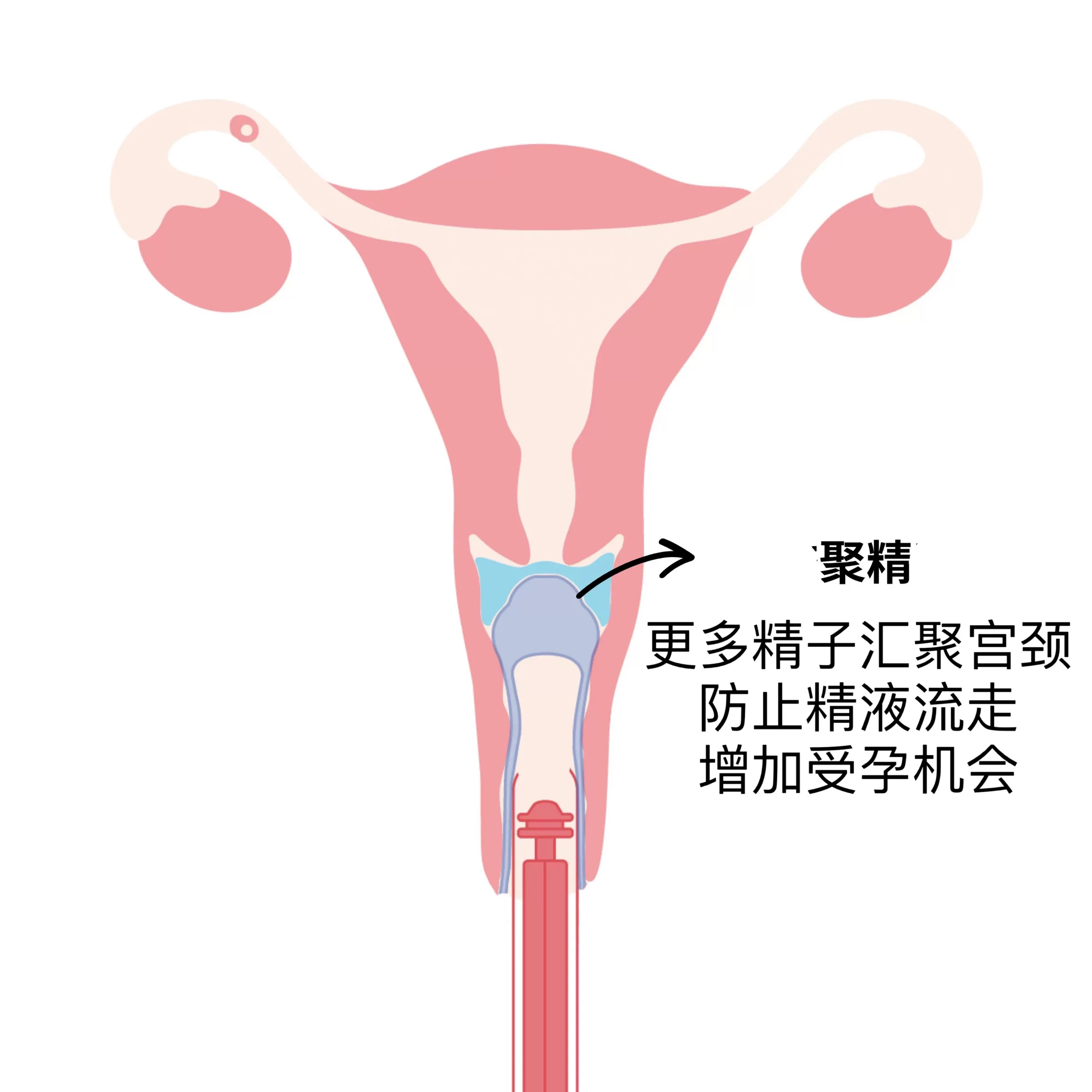 人工授精备孕输精推注器受孕器注射器自然采集科学调理精准监测