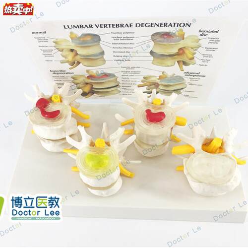 四分型腰椎模型正常与腰椎病变组合模型医学D人体骨骼腰椎模型