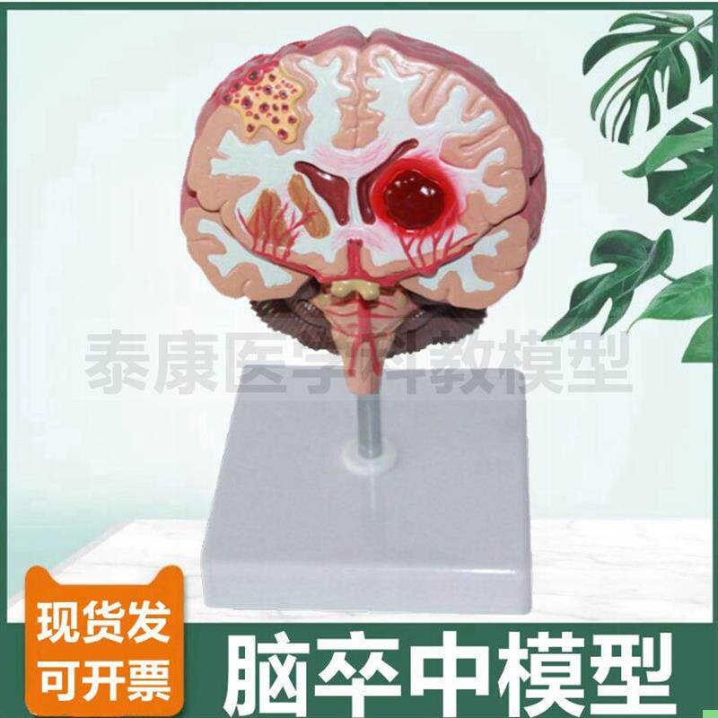 病理脑模型卒中破裂脑室血管医患沟通展示脑组织可拆卸功能区神经