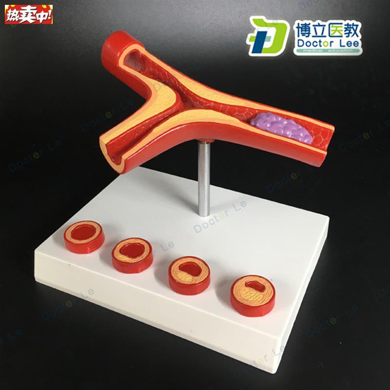 血管堵4塞血液浓I度脂肪病理血液血管粥样血管病理解剖模型