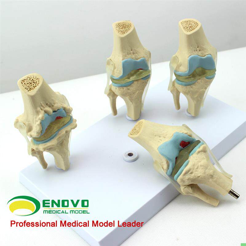 颐诺正品人体病理膝关节模型血友病退行性膝关节病发炎膝关节模型