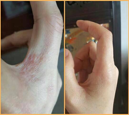 手痒水泡脱皮干裂季节性手气起小水泡痒膏手上起皮干燥修复霜