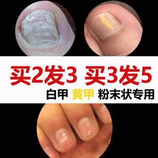 真菌性白甲手脚指甲发白发黄变白变黄增厚粉末碎末空甲分离亮甲油