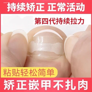 甲沟矫正器指甲矫正嵌甲神器纠正器脚趾甲贴片卷曲甲专用正甲扣炎