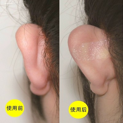 精灵耳贴可反复使用防水硅胶贴面耳变招风耳固定立耳矫正显小神器