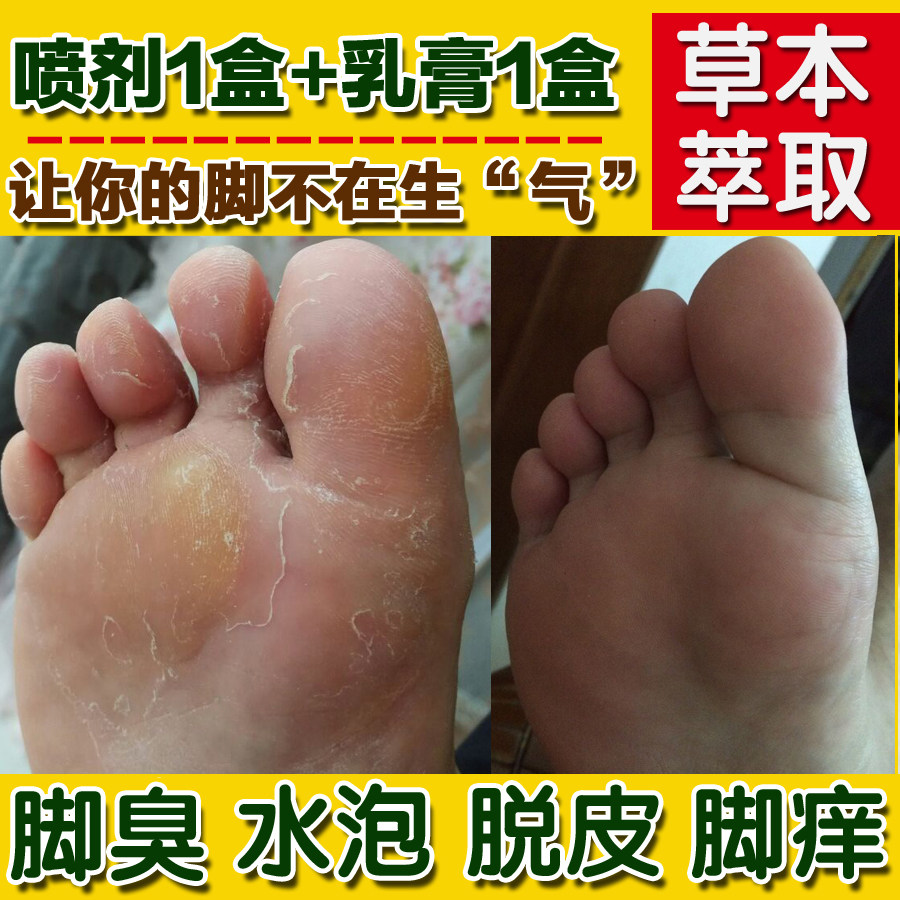 脚气止痒脱皮杀菌去真菌感染根水泡型膏烂脚丫药糜烂脚趾缝喷雾