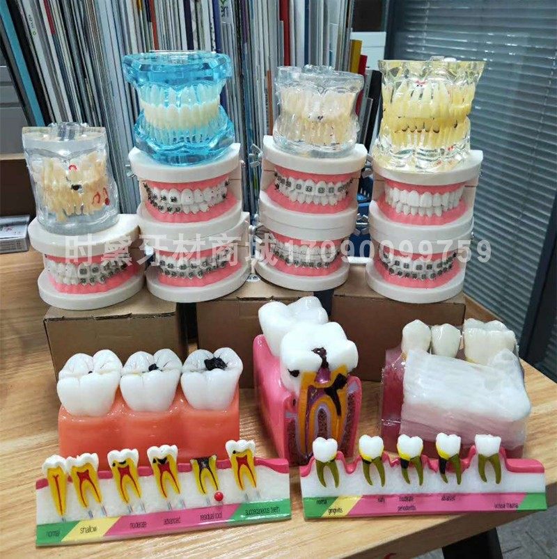 牙科牙周病理模型 种植牙模型 口腔医患沟通讲解龋齿演变分类模型