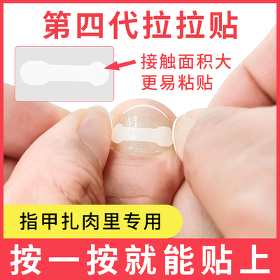 正甲贴甲沟嵌甲矫正器拉拉贴