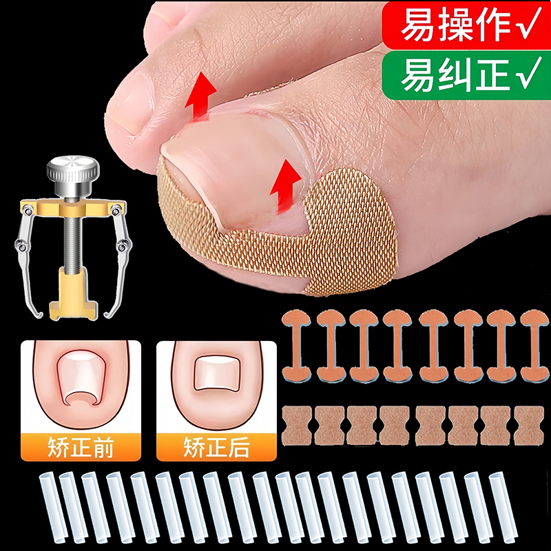 甲沟矫正器贴片纠正甲垫灰贴透气