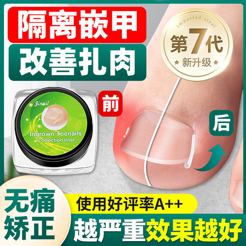 【无痛矫正】嵌甲填充垫甲沟