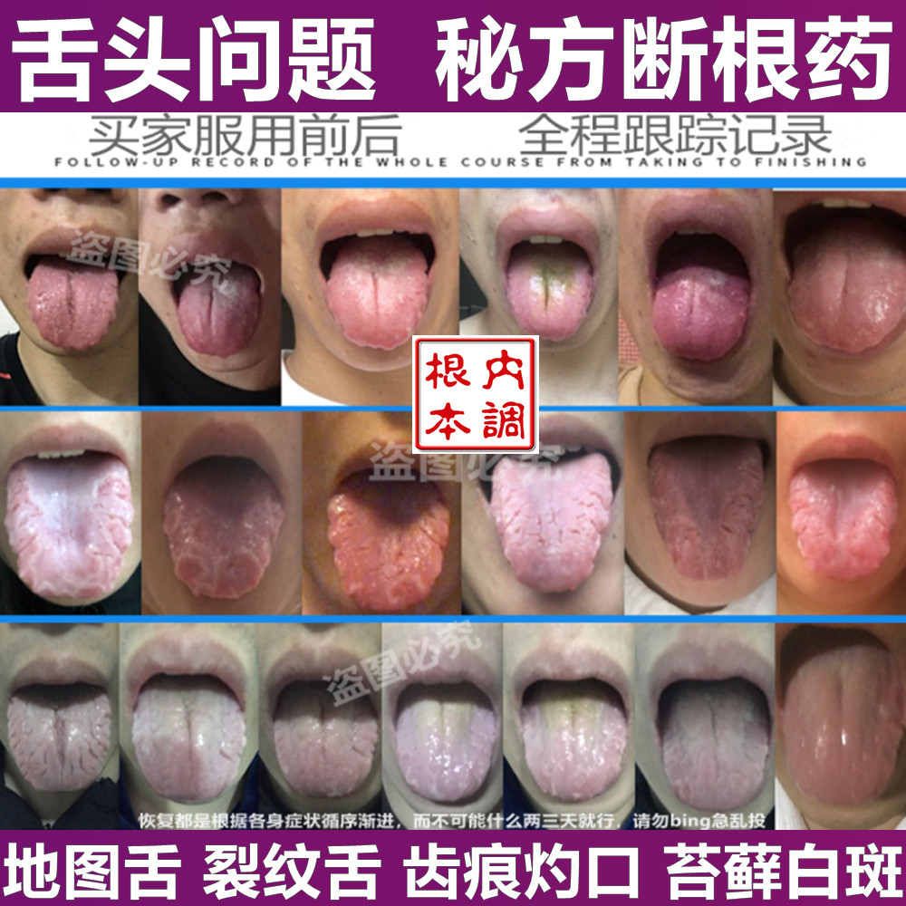 地图舌裂纹舌舌头裂纹舌头开裂地图舌花剥舌齿痕舌口疮灼口综合症