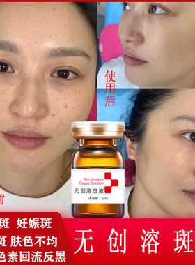 美容院微晶无创导入溶斑液淡化黑色素提亮排色液黄褐片状斑