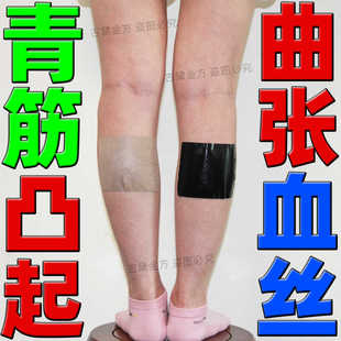静脉曲张舒筋曲张贴膏小腿酸沉胀痛敏感皮肤青筋凸起红血丝