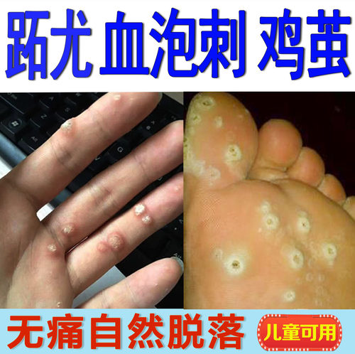 血胞刺去除膏血泡刺肉刺脚钉硬皮脚垫脚趾旁硬茧