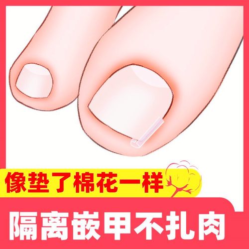 指甲矫正器嵌甲专用隔离填充垫