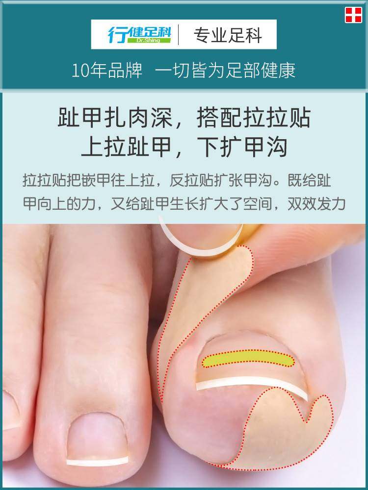 甲沟嵌甲矫正器贴片炎儿童指甲贴趾甲纠正神器专用工具长到肉里