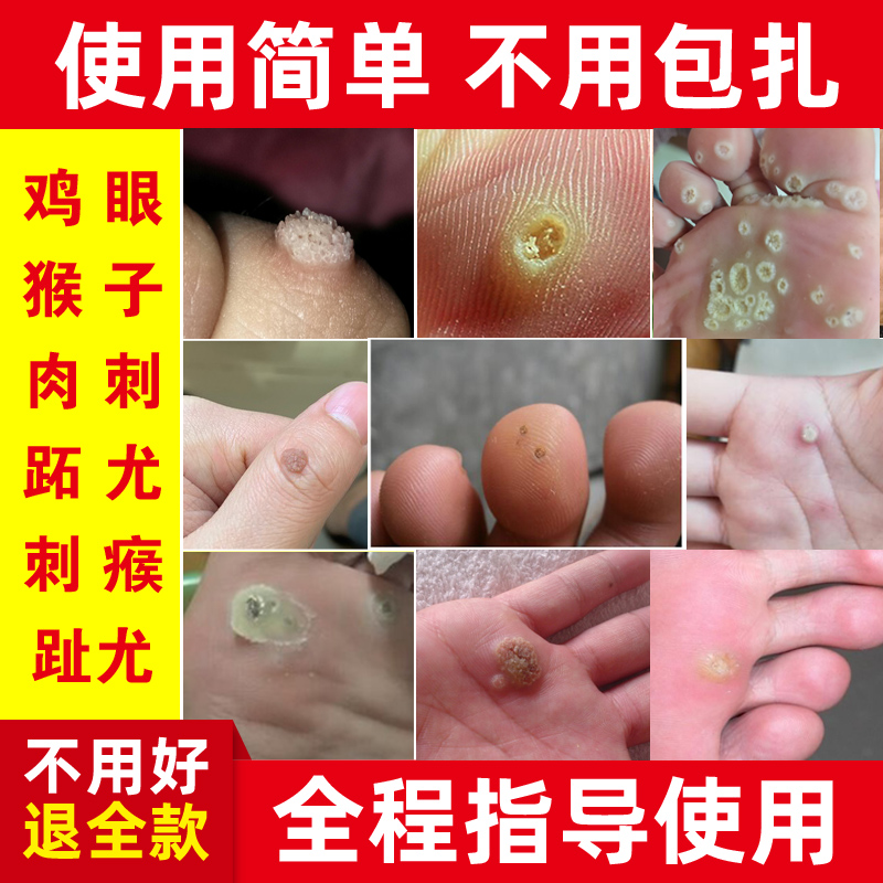 去除手足鸡眼跖疣瘊子肉刺拓疣膏