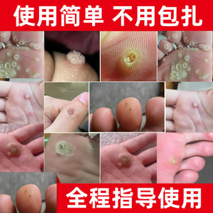 去除鸡眼跖疣专用祛手足肉刺猴脚底拓疣趾尤净灵除凸痦子神器根