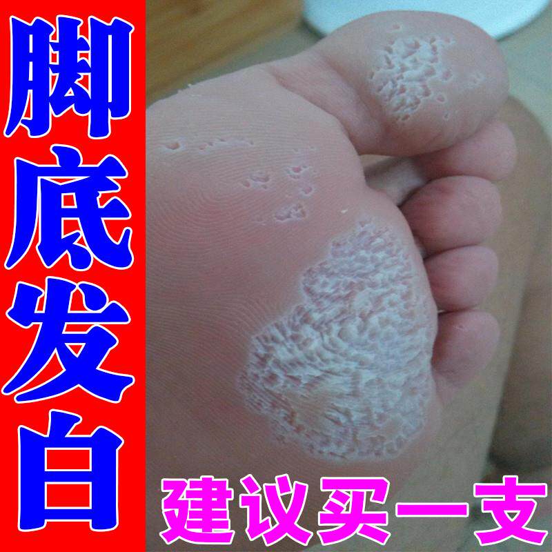 窝状角质松解症脚底起泡