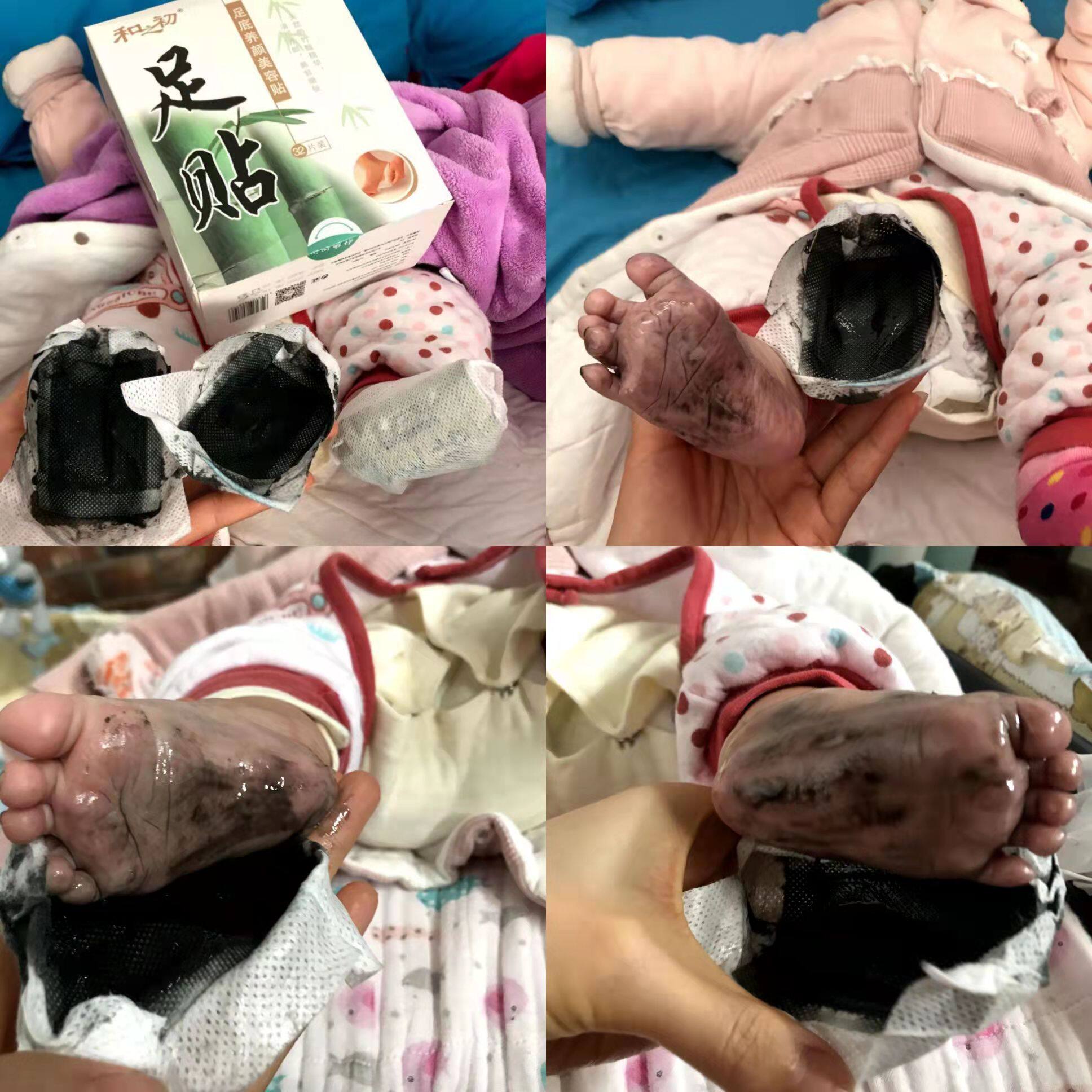 和之初足贴养颜美容贴排出体内湿气寒气孩子着凉也可以贴
