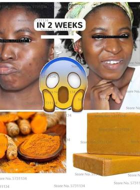Tumeric Soap Natural Lightening Acne Dark Spots Brighter