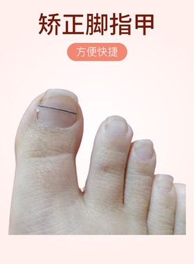 展宽钛合金记忆正甲丝EPR嵌甲专用矫正丝脚指甲弹力丝甲沟钢丝厂