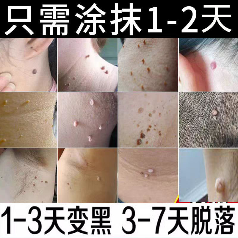 颈部脖子上小肉球肉粒肉刺疙瘩赘肉丝状疣瘊子去除神器腋下手脚脸