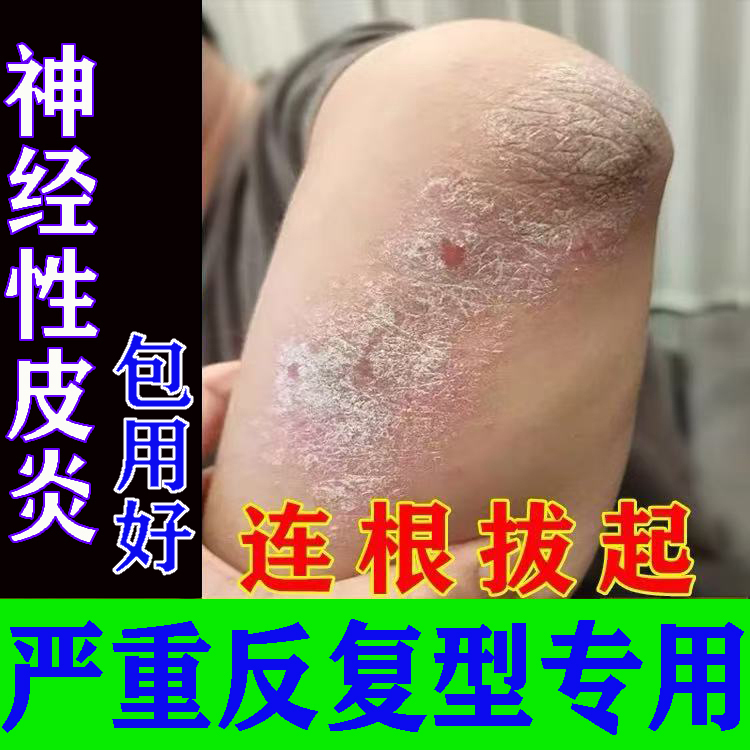 神经性皮炎脂溢性治疗去外根用膏顽固无激素止痒湿特疹效真菌感染