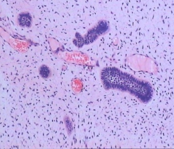 人牙源性纤维瘤口腔病理组织切片标本医学院校教学用品高教片