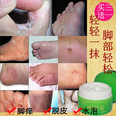脚气止痒脱皮杀菌真菌感染专用去脚后跟干裂烂脚丫糜烂脚趾根特效