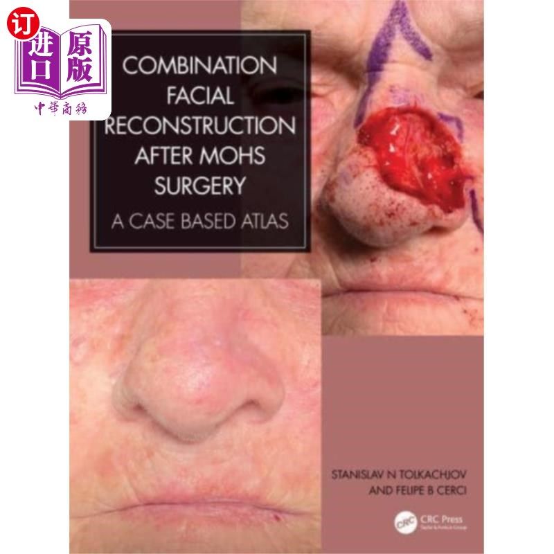 海外直订医药图书Combination Facial Reconstruction after Mohs Sur... 莫氏手术后联合面部重建
