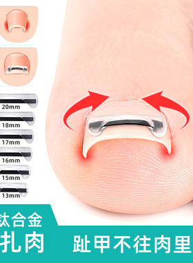 第五代半月钛合金正甲贴片甲沟嵌甲卷甲拉拉正甲矫形器弹力