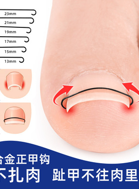 正甲钩甲沟嵌甲脚趾甲指扎肉里记忆合金矫形器正甲扣