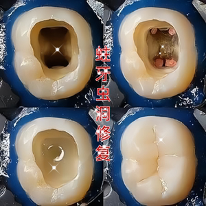 不净包退-蛀牙神器 防蛀牙齿洞牙裂牙缝坏牙牙虫牙蠕 清新口气