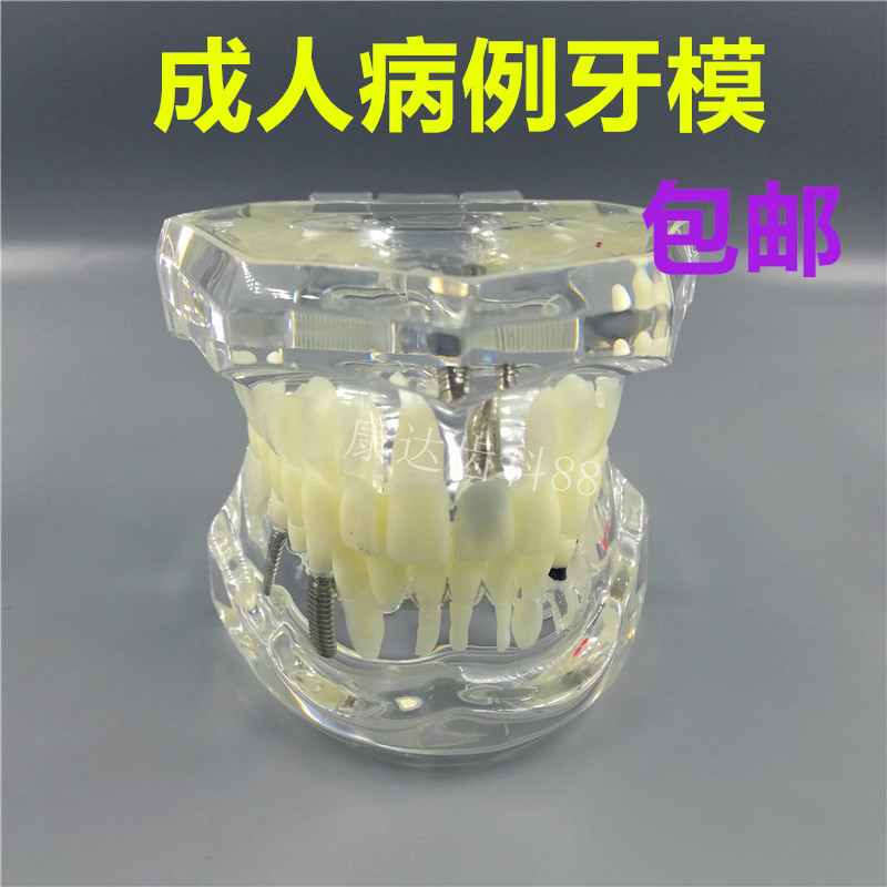 口腔模型 标准牙模 牙科 标准病理病例演示 种植牙讲解 齿科材料