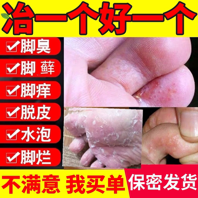 角化型脚气去脚后跟干裂开裂脱皮专用特杀菌真菌感染止根效痒药房