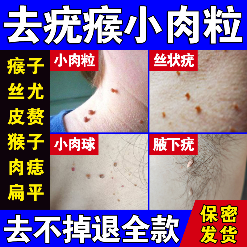 脖子上长小肉球肉粒肉刺疙瘩赘肉候子神器腋下一模无忧私处克尤液