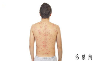 日清肤宁后背痒背部皮肤止痒背上痘痘长痘闭合红疙瘩喷剂外用喷剂