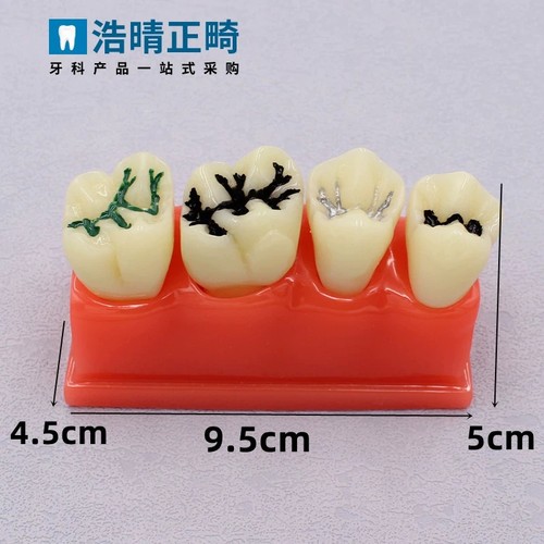 牙科口腔牙齿窝沟封闭说明模型儿童龋齿封闭嵌体修复模拟