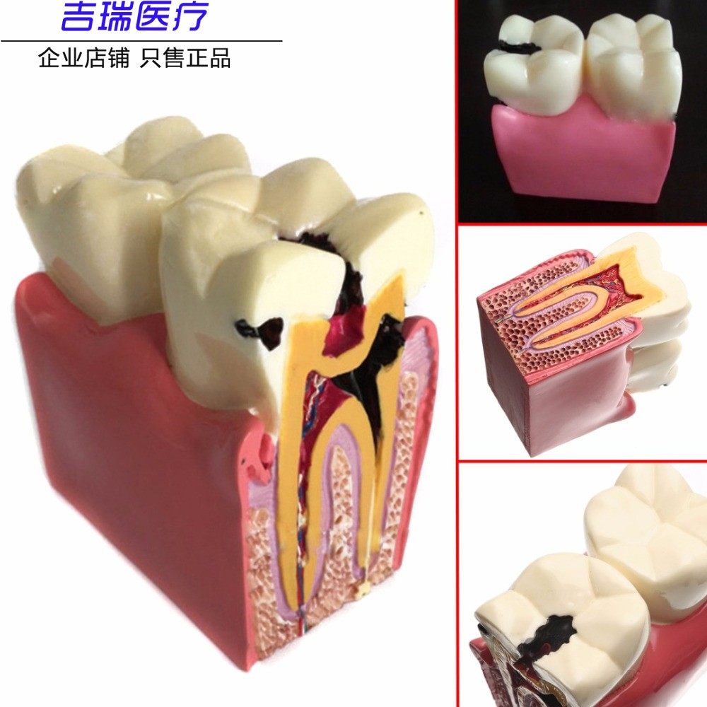 牙科 牙齿模型 6倍龋齿对比模型 口腔模型 医患沟通教学模型包邮